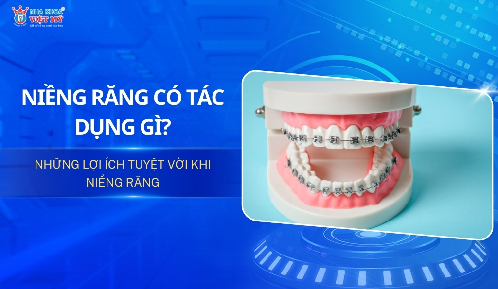 Niềng răng có tác dụng gì? Những lợi ích tuyệt vời khi niềng răng