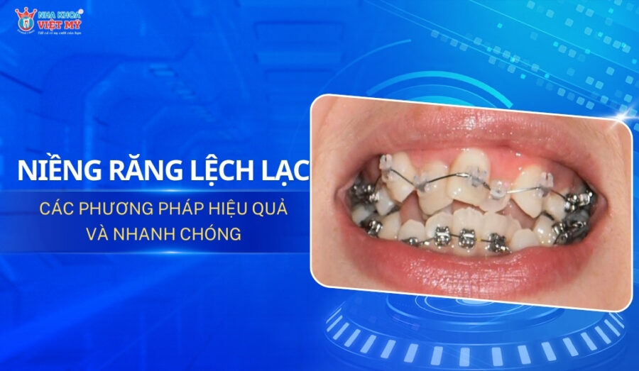 thumbnail niềng răng lệch lạc