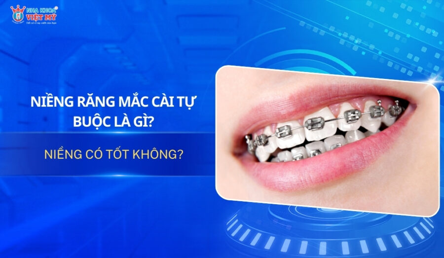 thumbnail niềng răng mắc cài tự buộc