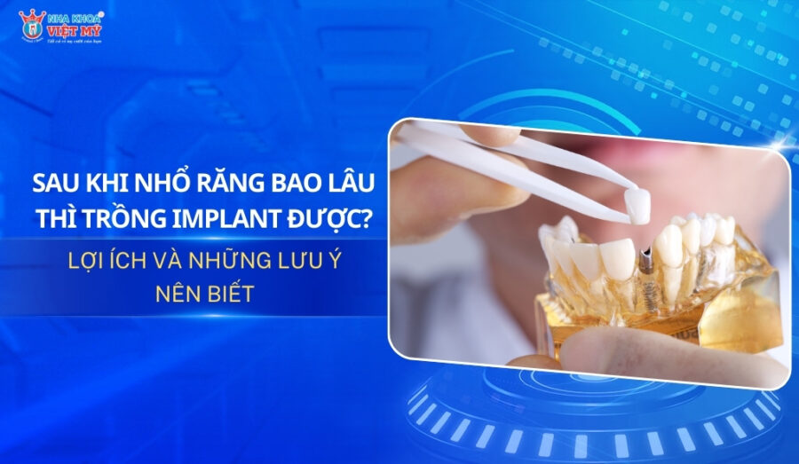 thumbnail sau khi nhổ răng bao lâu thì trồng implant