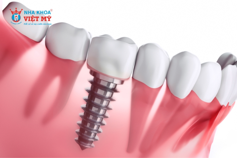 Trụ Implant là chân răng nhân tạo được cấy vào xương hàm