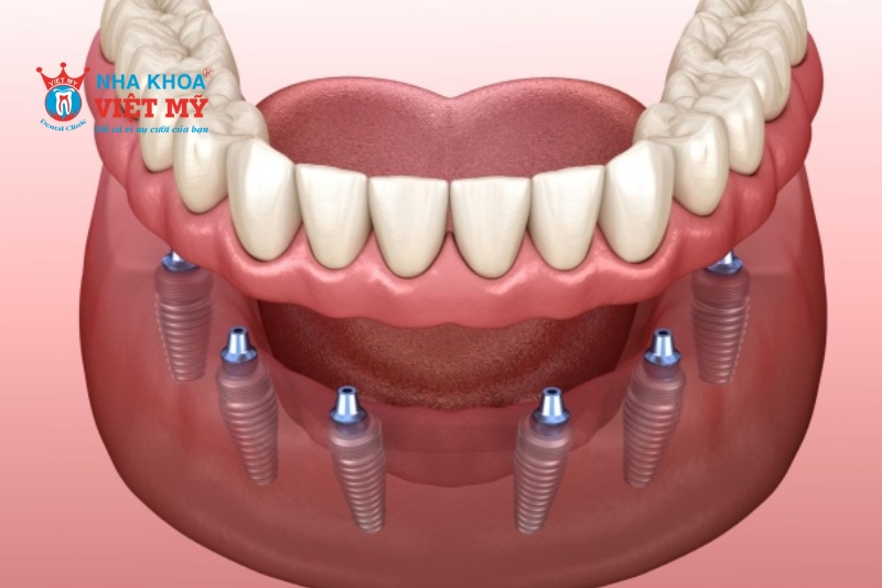 Vị trí cấy ghép tác động đến việc lựa chọn kích thước trụ Implant cho phù hợp