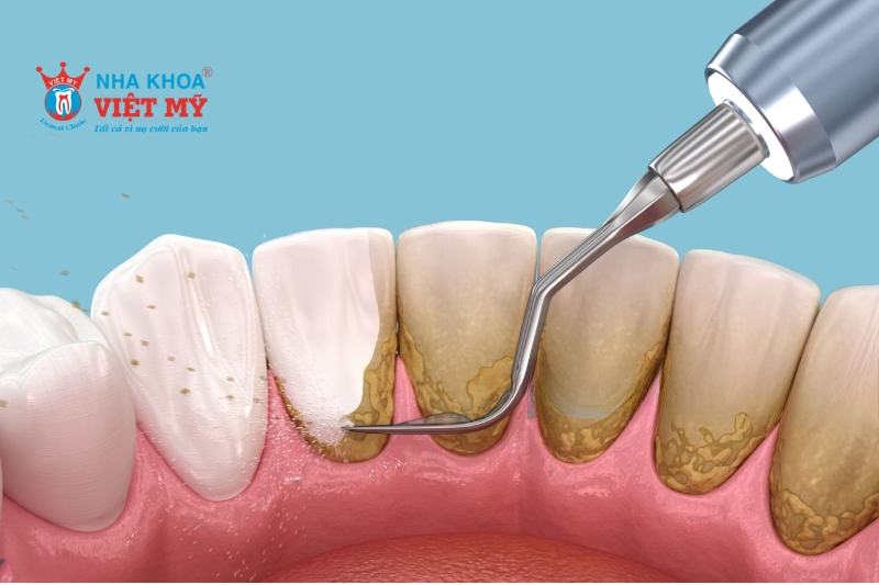 Không nên quá lạm dụng cạo vôi răng để tránh mòn men răng và tổn thương nướu