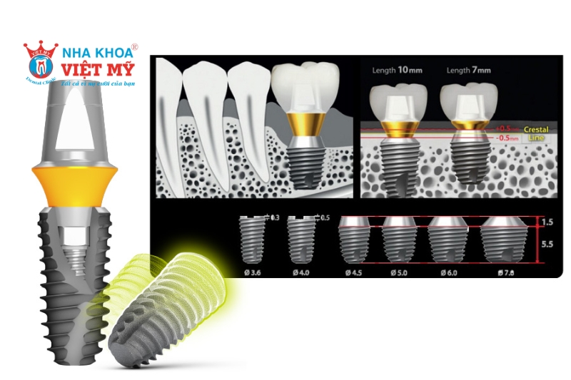 Công nghệ xử lý vùng cổ của trụ Implant Mỹ