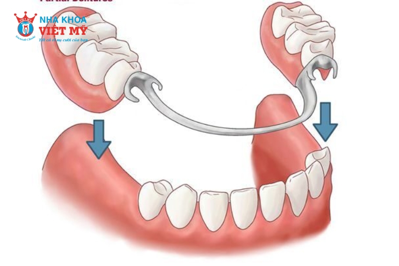 Hàm tháo lắp trong trồng răng hàm