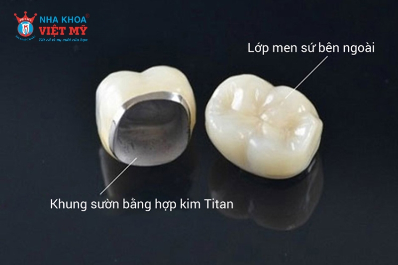 Răng sứ Titan - Bản cải tiến của răng sứ kim loại