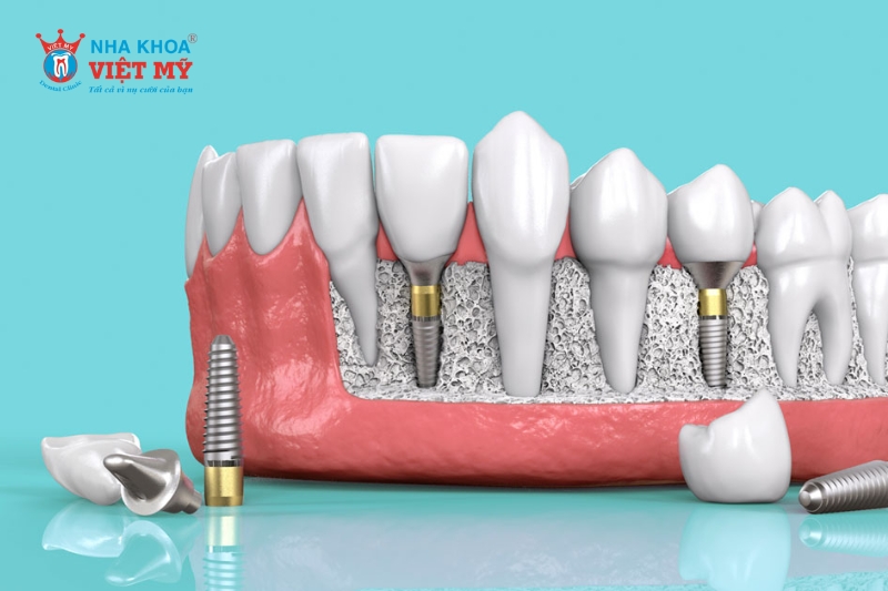 Trồng răng Implant là một trong những phương pháp phục hình răng hiện đại