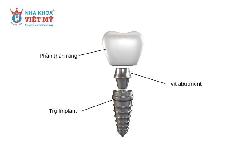 Abutment đóng vai trò là khớp nối giữa trụ Implant và mão răng sứ