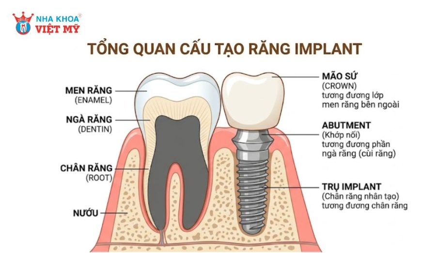 Cấu tạo răng Implant gồm 3 phần: trụ implant, abutment và mão sứ