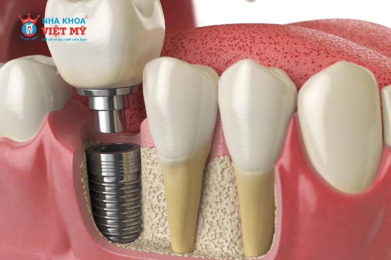 Chi phí cấy ghép xương hàm để cắm Implant có giá khá cao tùy vào kỹ thuật