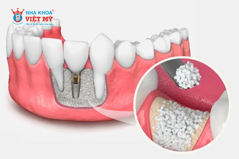 Chi phí cấy ghép xương cắm Implant còn phụ thuộc vào nhiều yếu tố