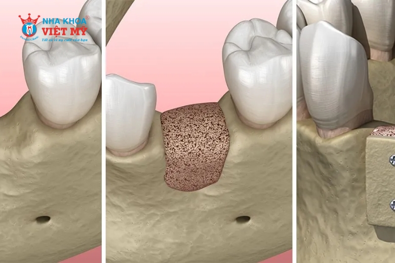 Phẫu thuật cấy ghép xương hàm có được bảo hiểm không?