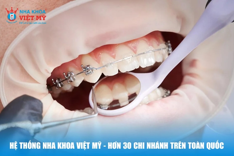 Niềng răng thưa hiệu quả, uy tín tại Nha khoa Việt Mỹ