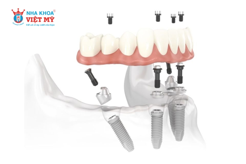 Phục hình bắn vít trên Implant mang lại nhiều lợi ích đáng kể