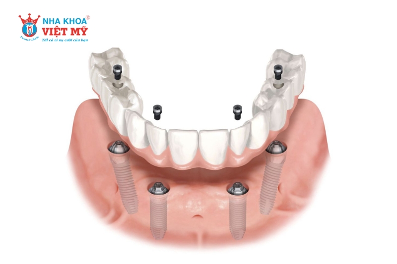 Phục hình cắm vít trên Implant cũng có một số nhược điểm tồn tại