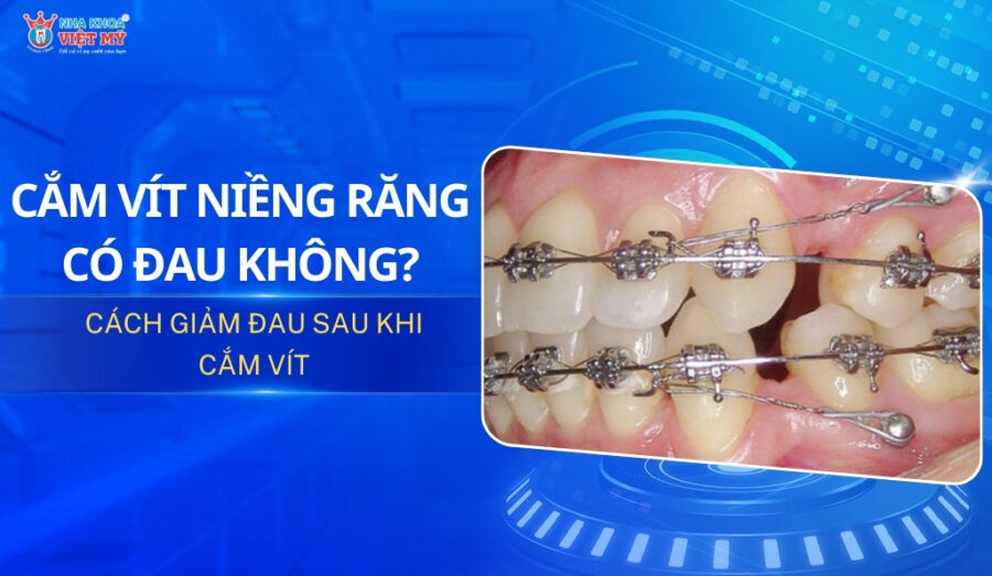 thumbnail cắm vít niềng răng có đau không