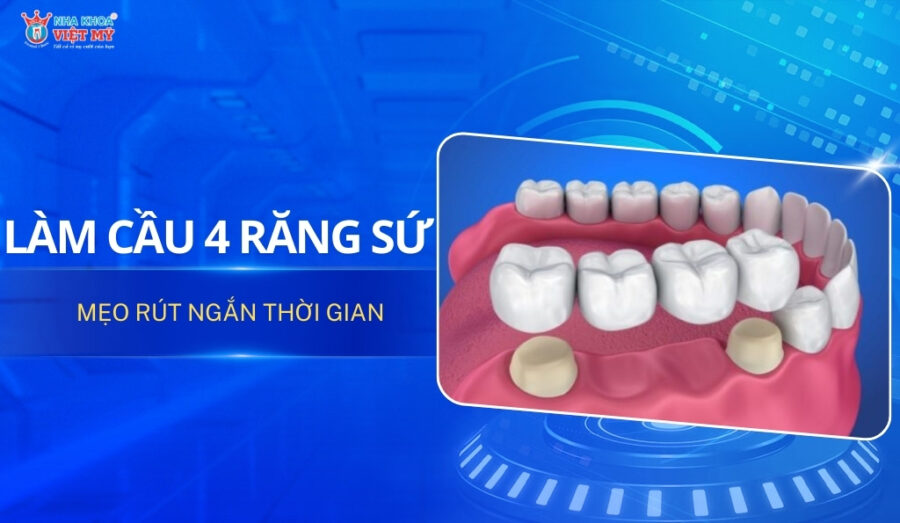 thumbnail cầu 4 răng sứ