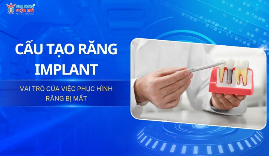 Cấu tạo răng Implant và vai trò trong phục hình răng mất