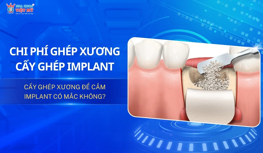 Chi phí cấy ghép xương để cấy ghép Implant là bao nhiêu?