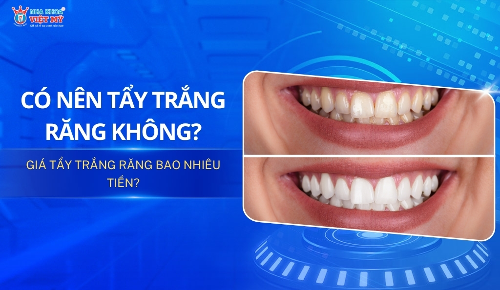 Có nên tẩy trắng răng không? Giá bao nhiêu?