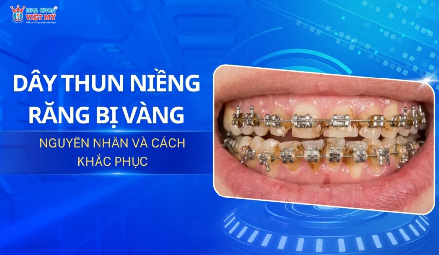 thumbnail dây thun niềng răng bị vàng