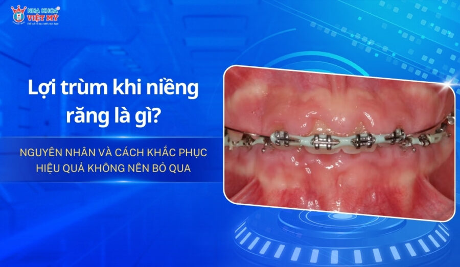 Nguyên nhân và cách khắc phục lợi trùm khi niềng răng