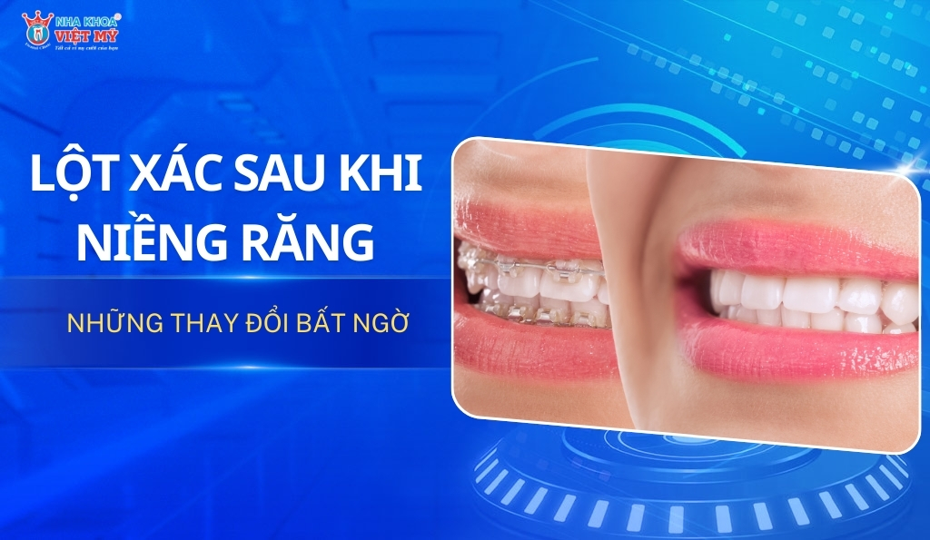 thumbnail lột xác sau khi niềng răng