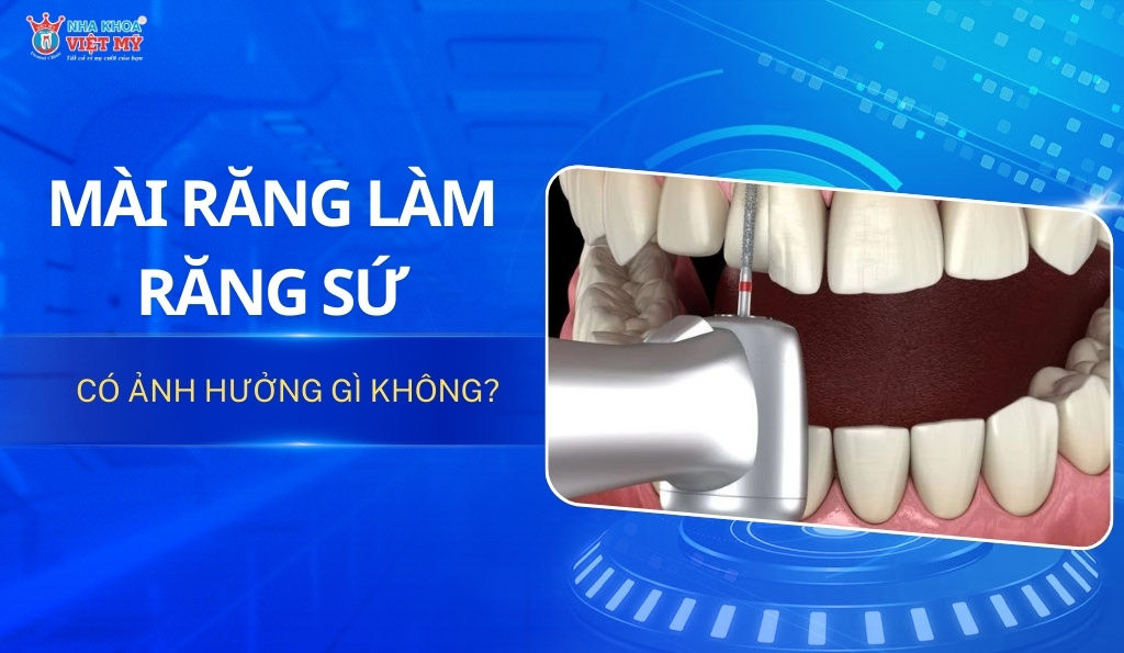 thumbnail mài răng làm răng sứ