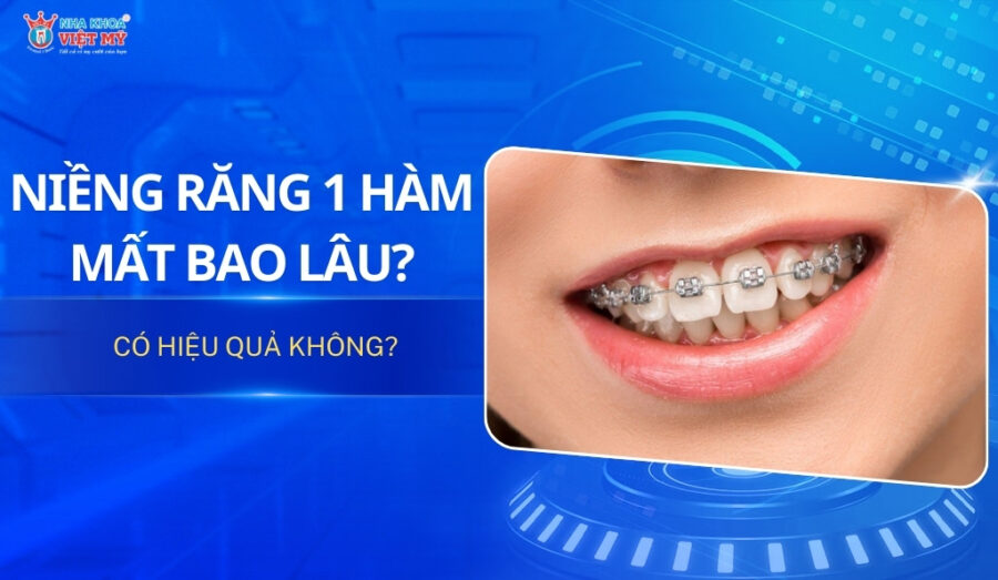 thumbnail niềng răng 1 hàm mất bao lâu