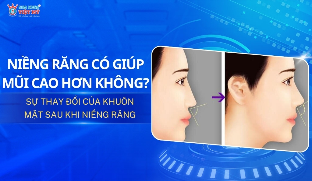 thumbnail niềng răng có giúp mũi cao hơn không