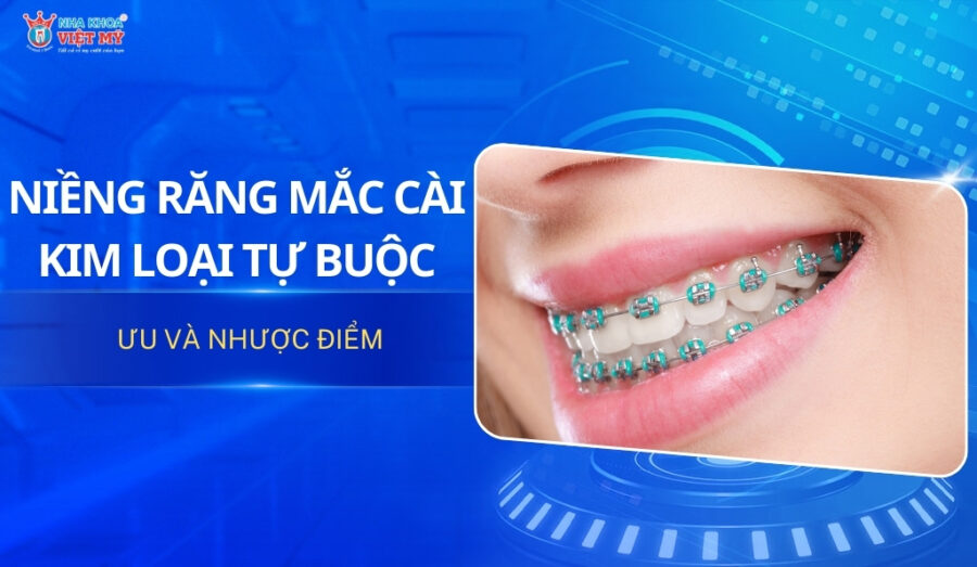 thumbnail niềng răng mắc cài kim loại tự buộc