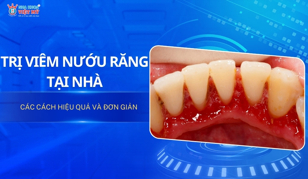 Thumbnail trị viêm nướu răng tại nhà