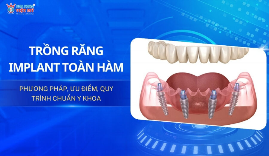 Trồng răng Implant toàn hàm: Phương pháp, ưu điểm, quy trình