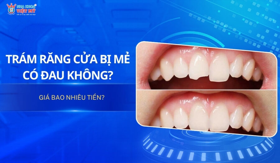 thunmbnail trám răng cửa bị mẻ có đau không