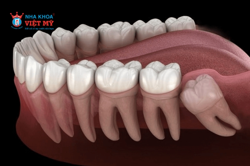 Không mọc răng khôn có thể giúp tránh nhiều biến chứng