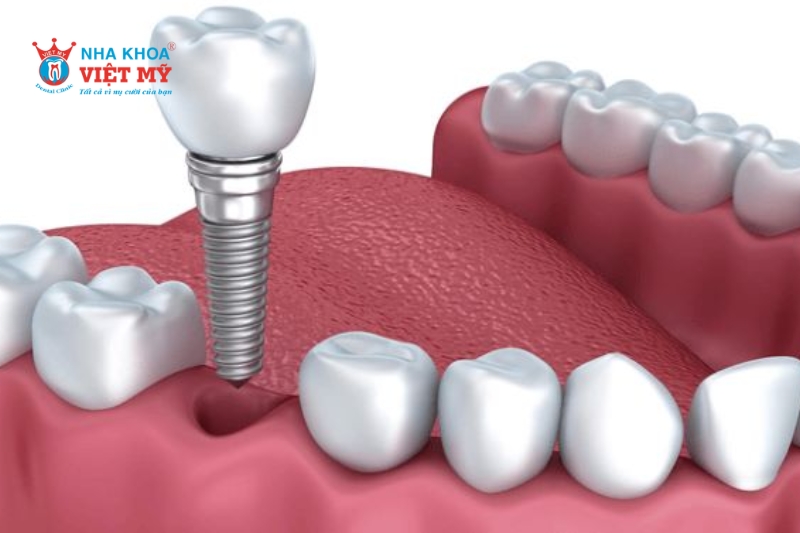 Trồng răng Implant cho răng chết tủy