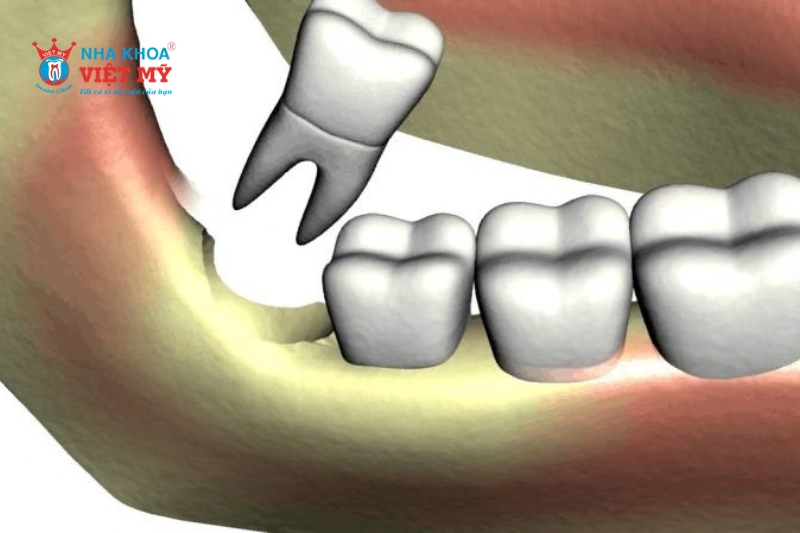 Nên tham khảo ý kiến bác sĩ trươc khi quyết định nhổ răng khôn mọc lệch 45 độ