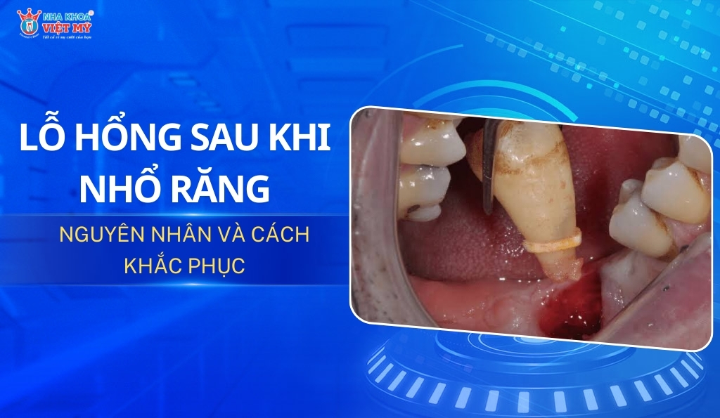 thumbnail lỗ hổng sau khi nhổ răng