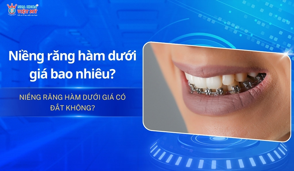 niềng răng hàm dưới giá bao nhiêu tiền? giá có đắt không