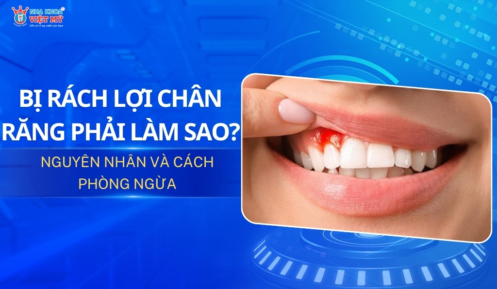 Thumbnail rách lợi chân răng