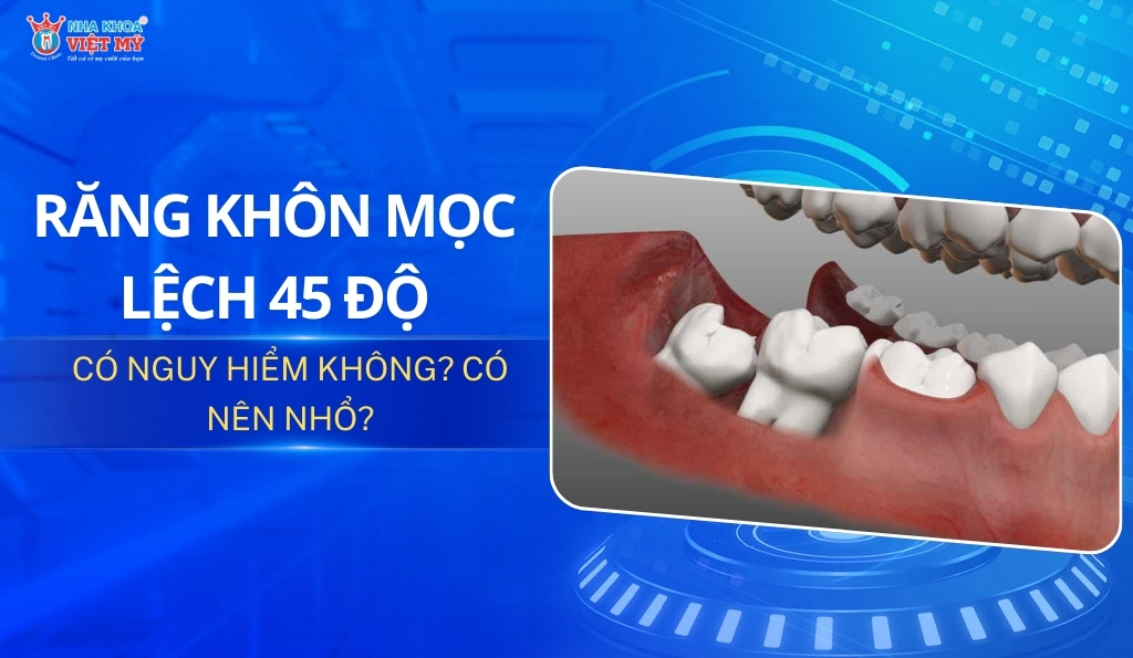 thumbnail răng khôn mọc lệch 45 độ