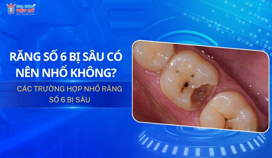 thumbnail răng số 6 bị sâu có nên nhổ không