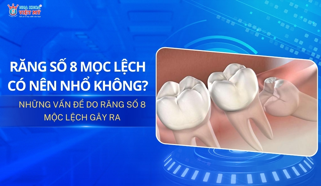 thumbnail răng số 8 mọc lệch có nên nhổ không