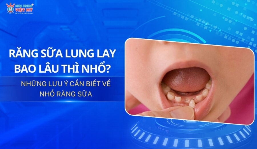 thumbnail răng sữa lung lay bao lâu thì nhổ