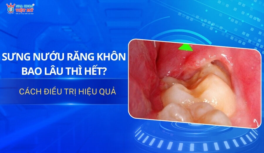 thumbnail sưng nướu răng khôn bao lâu thì hết