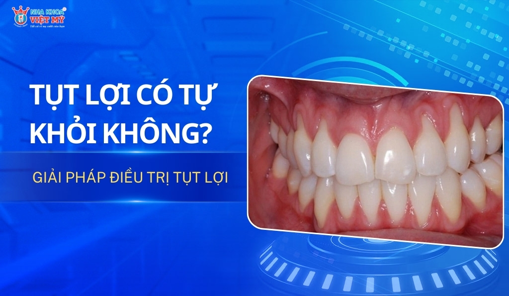 thumbnail tụt lợi có tự khỏi không