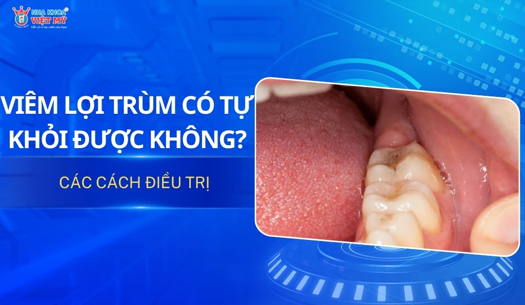 thumbnail viêm lợi trùm có tự khỏi được không