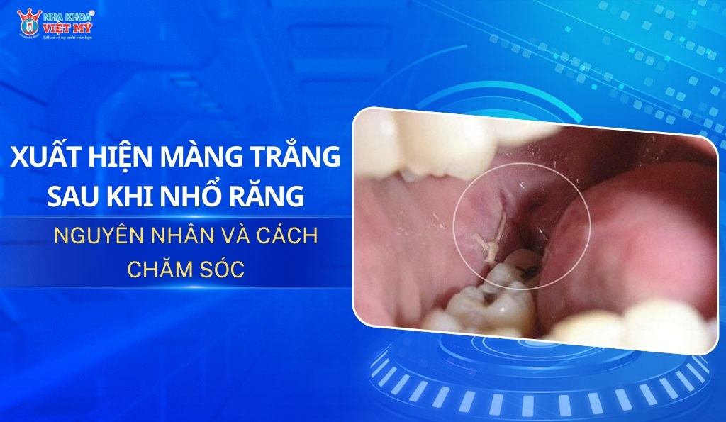 thumbnail xuất hiện màng trắng sau khi nhổ răng