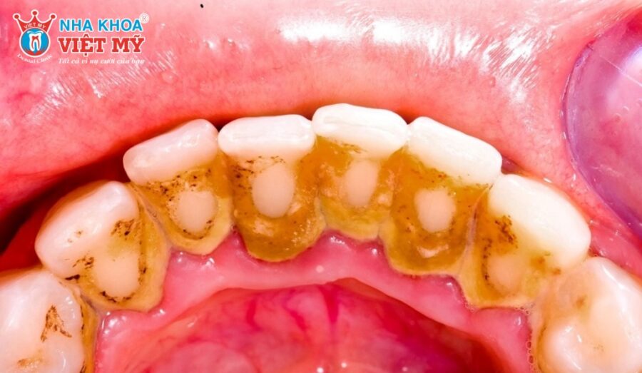 Nên đi khám nha khoa định kỳ để hạn chế vôi răng tích tụ quá nhanh