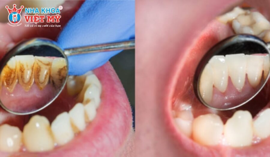 Lấy vôi răng ở nha khoa uy tín như Nha khoa Việt Mỹ sẽ đảm bảo an toàn, hiệu quả